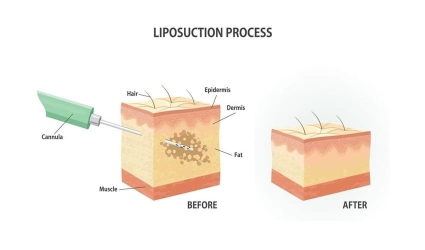 Be Fat-Free Through Liposuction Surgery