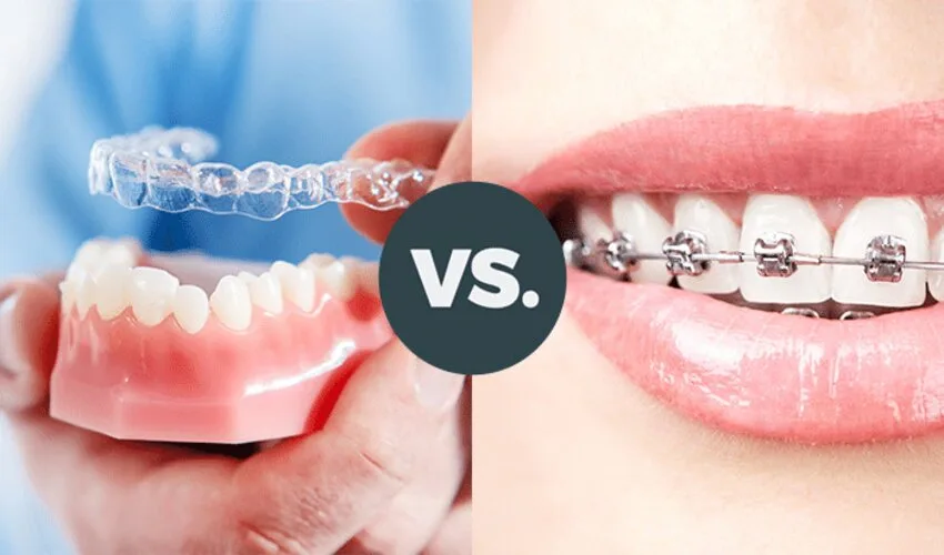 Braces vs. Aligners