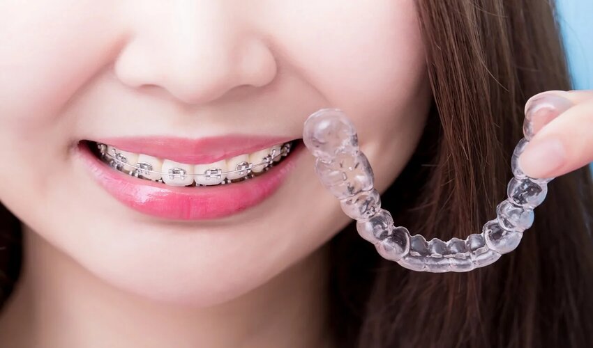How Does Invisalign Treatment Work?