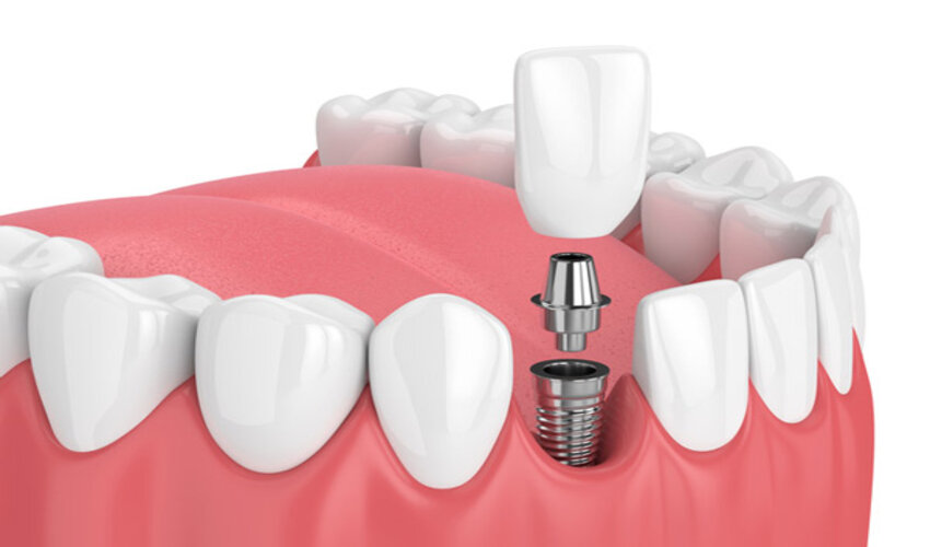 The Smile You Deserve: Navigating Insurance Coverage for Dental Implants