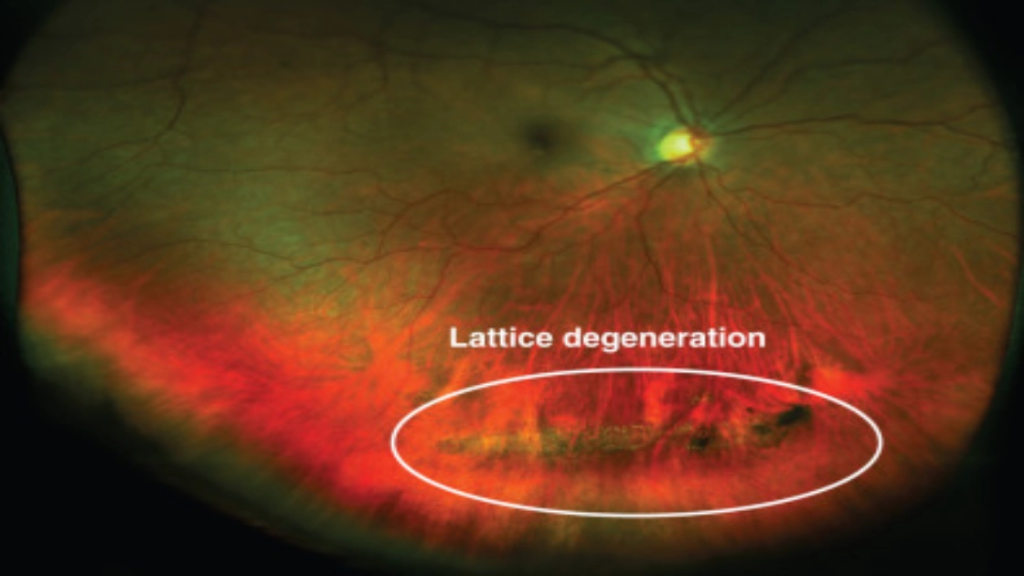 Lattice Retinal Degeneration 1.webp