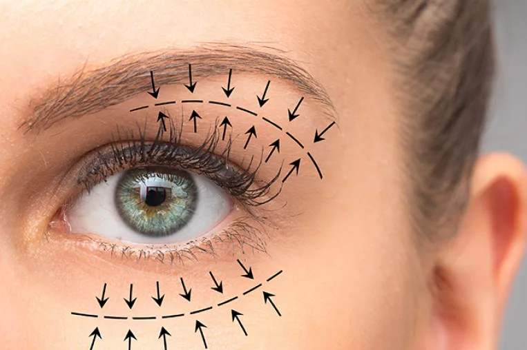 blepharoplasty 2.png