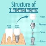 dentalimplants 1 1.jpg