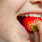 strawberry allergy.jpg.webp