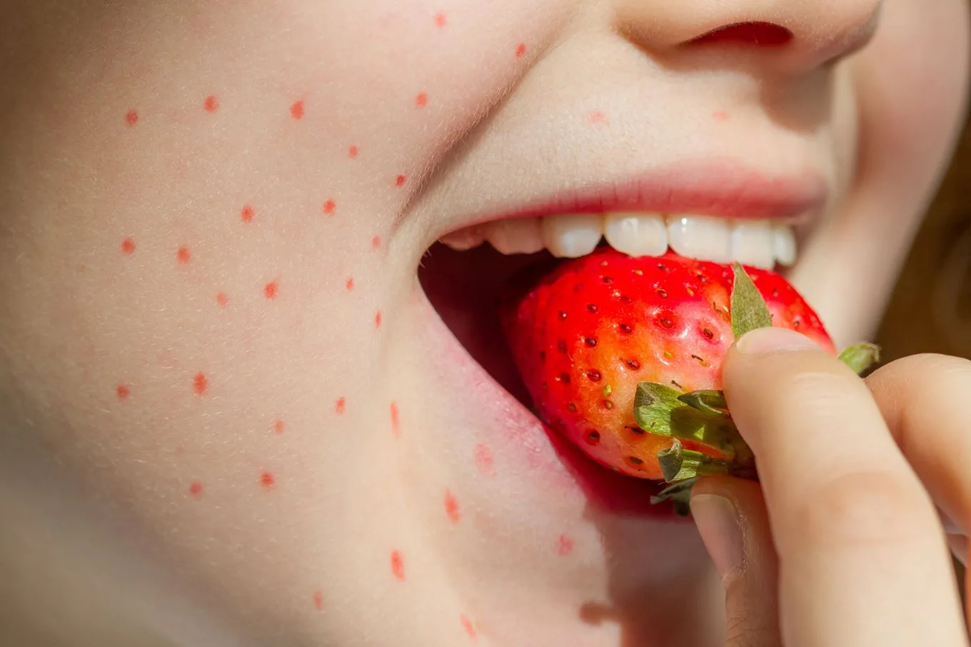 strawberry allergy.jpg.webp